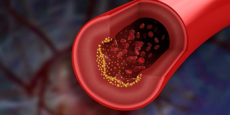 Trombectomía Mecánica ¿en Qué Consiste Revista Instituto De Neurocirugía 8502